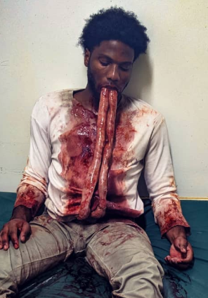 Intestine Patient